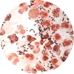 NEISSERIA GONORRHOEAE (GONOREJA)
